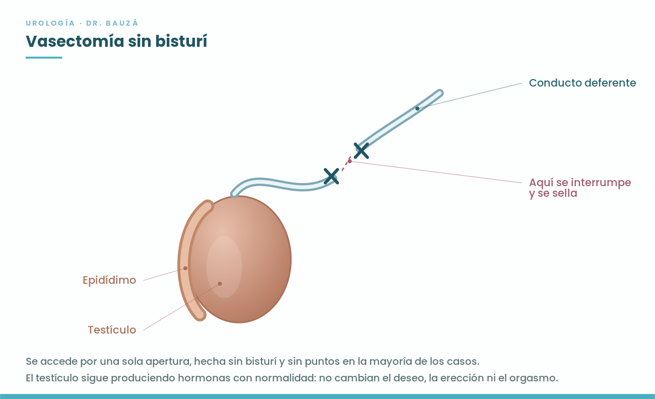 Esquema de la vasectomía sin bisturí: testículo, epidídimo y conducto deferente interrumpido y sellado