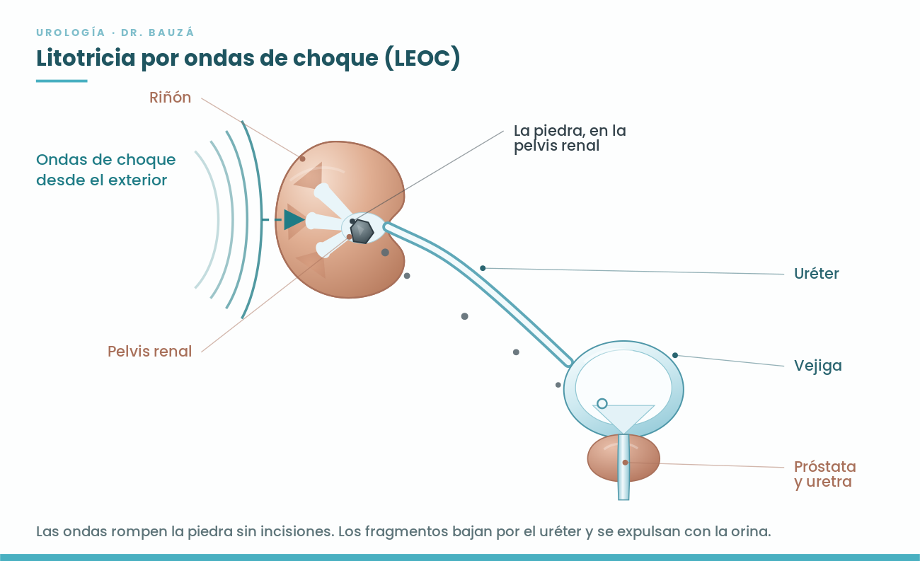 Esquema de la litotricia por ondas de choque: las ondas fragmentan la piedra del riñón desde el exterior