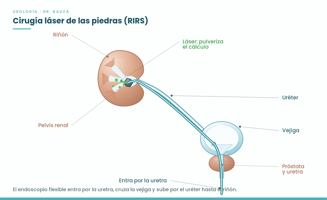 Esquema de la cirugía láser de las piedras del riñón por la vía urinaria natural