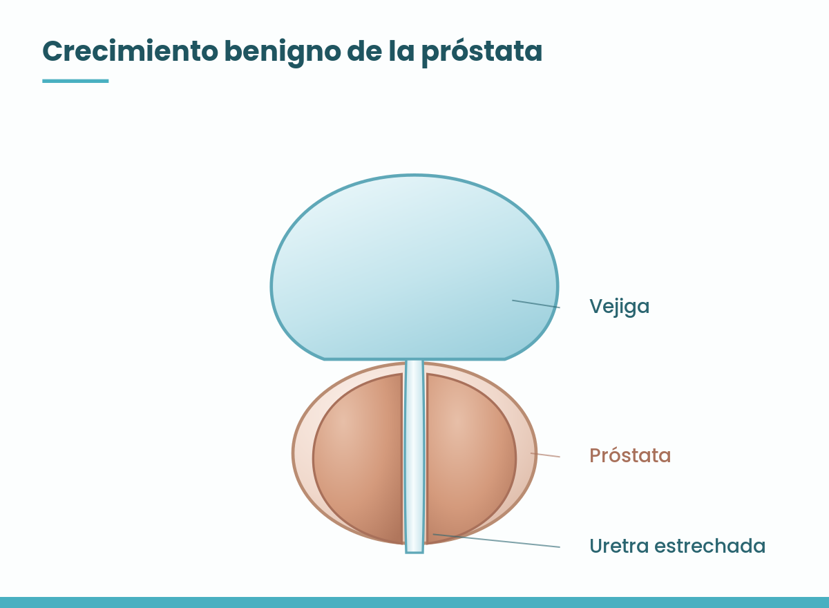 Esquema del crecimiento benigno de la próstata y la uretra estrechada