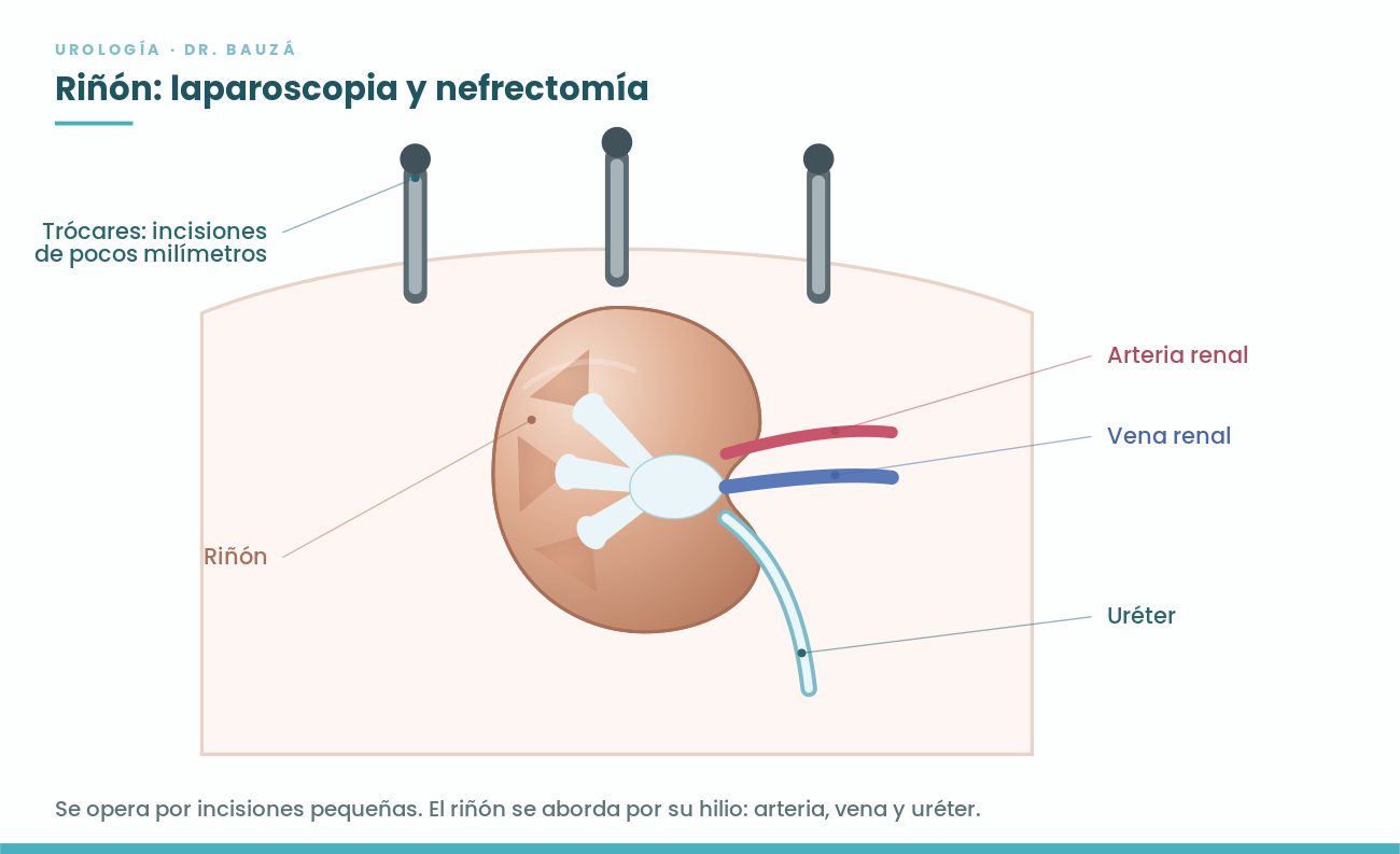 Esquema del riñón en laparoscopia: hilio con arteria renal, vena renal y uréter, y trócares