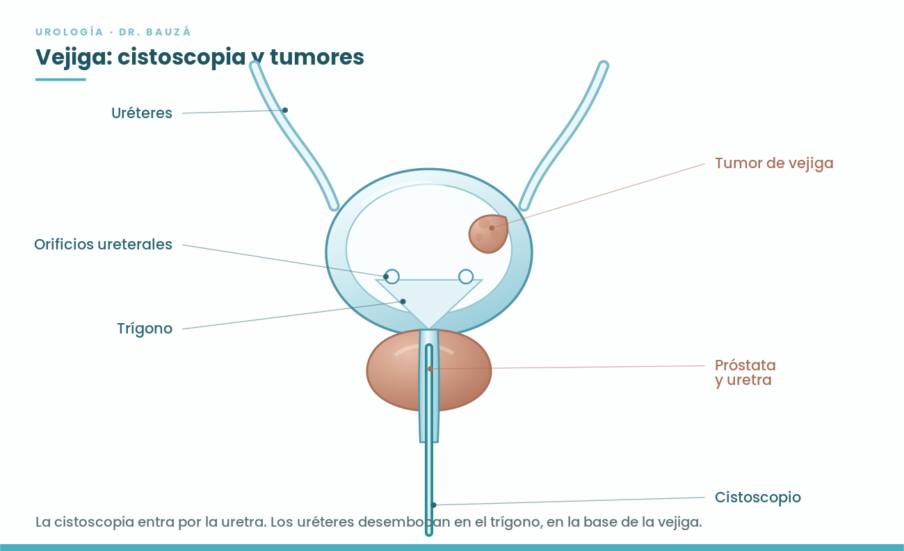 Esquema de la vejiga: uréteres, trígono, tumor vesical y cistoscopio entrando por la uretra