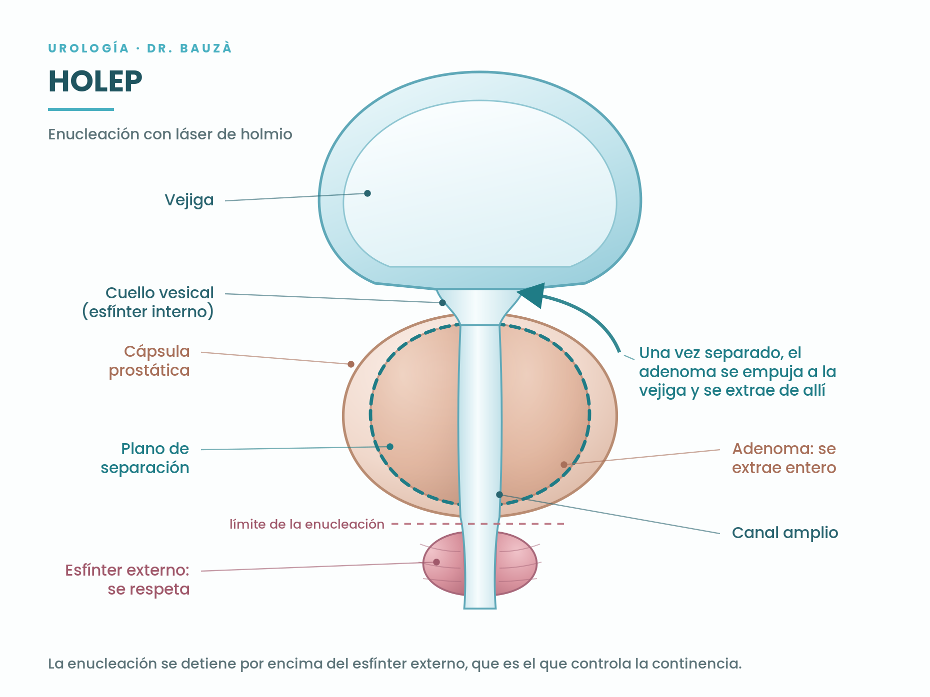 Esquema del HOLEP: enucleación del adenoma prostático respetando el esfínter externo, ilustración del Dr. Bauzá, urólogo en Palma y Manacor